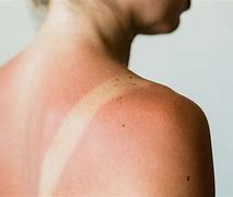 Image result for Irritation Sun Burn