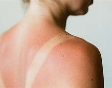 Image result for SunBurn On Black Skin