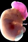 Image result for Neural Tube Defects