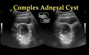Image result for Complex Adnexal Cyst