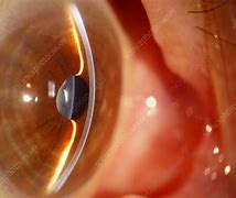 Image result for Open Vs. Closed Angles Slit Lamp