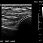 Image result for Shoulder Joint Fracture