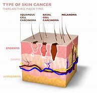 Image result for Types of Skin Cancer Cells
