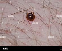 Image result for Tick Attached to Skin