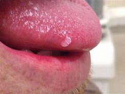 Image result for Small Quamous Papilloma Tongue