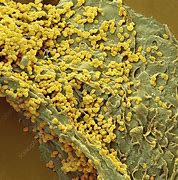 Image result for Molluscum Contagiosum and HIV