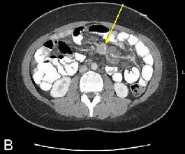 Image result for Carcinoid Tumor CT Scan