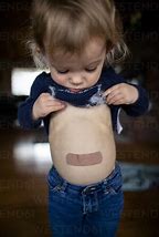 Image result for Distended Belly of Child