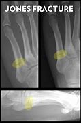 Image result for Jones Fracture Left Foot