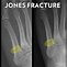 Image result for 4th Metatarsal Jones Fracture