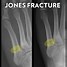 Image result for Jones Fracture X-ray