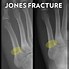 Image result for Walking On a Jones Fracture