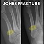 Image result for Fifth Metatarsal Stress Fracture