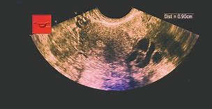 Image result for 4 Cm Ovarian Cyst