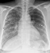 Image result for Viral Pneumonia Chest X-Ray