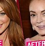 Image result for Lindsay Lohan Before Surgery