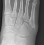 Image result for Accessory Bones Ankle