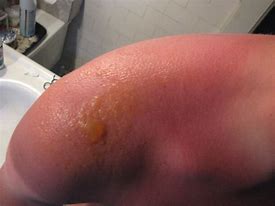 Image result for Sun Burn with Small Blisters