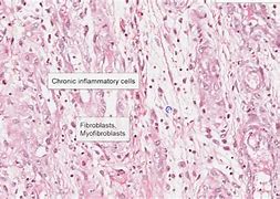 Image result for Periungual Granulation Tissue