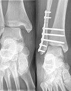 Image result for Broken Dislocated Ankle Female