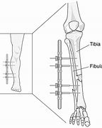 Image result for Femoral Fixation Device