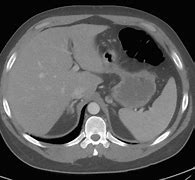 Image result for Adrenal Hemorrhage