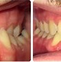 Image result for Narrow Lower Jaw