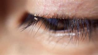Image result for Lash Lice