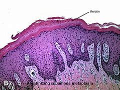 Image result for Squamous Metaplasia Bladder