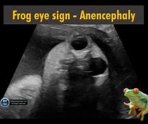 Image result for Frog Like Baby Anencephaly