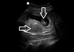 Image result for Uterine Fibroids and Pregnancy