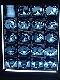 Image result for Bilateral Ovarian Cysts