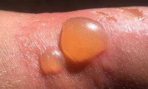 Image result for Sun Blisters On Hands
