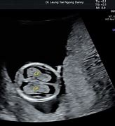 Image result for Choroid Plexus Fetal Ultrasound