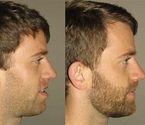 Image result for Upper Jaw Surgery