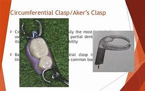 Image result for Circumferential Clasp