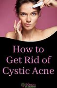 Image result for Cystic Acne Treatment