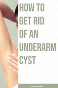 Image result for Armpit Cyst