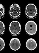 Image result for Normal Brain CT Scan Head