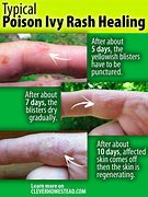 Image result for Poison Ivy Oak and Sumac Rashes