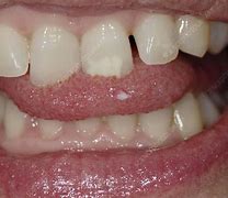 Image result for Squamous Cell Papilloma in Mouth