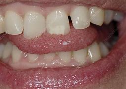 Image result for Tongue Papilloma