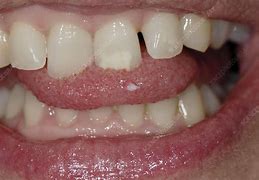 Image result for HPV On Tip of Tongue