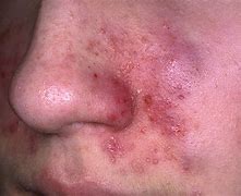 Image result for Eczema