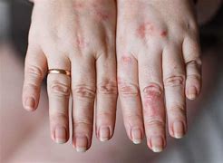 Image result for Allergic Reaction Rash to Laundry Detergent