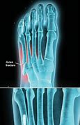 Image result for Jones Fracture Treatment