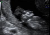 Image result for Anencephaly On Ultrasound