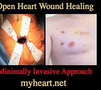 Image result for Heart Surgery Wound Healing