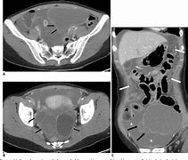 Image result for Ruptured Ovarian Cyst