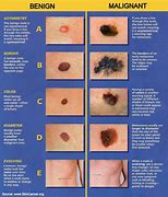 Image result for Small Black Mole Melanoma